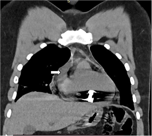 Coronal CT image showing foreign body with in the myocardium of the right ventricle (white arrow).