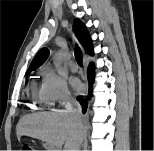 Sagittal image depicting foreign body within the myocardium (white arrow).