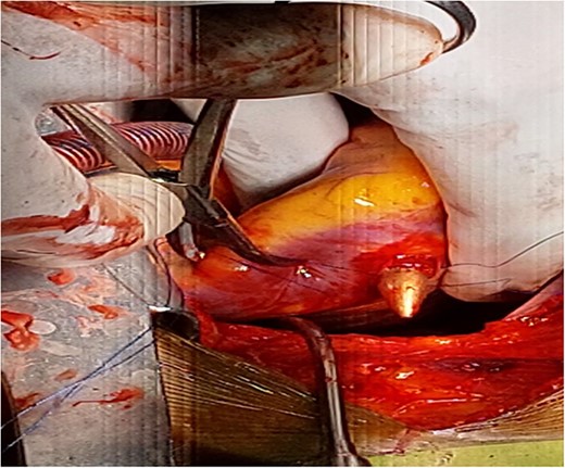 Partially extruded bullet located within the right ventricle wall.