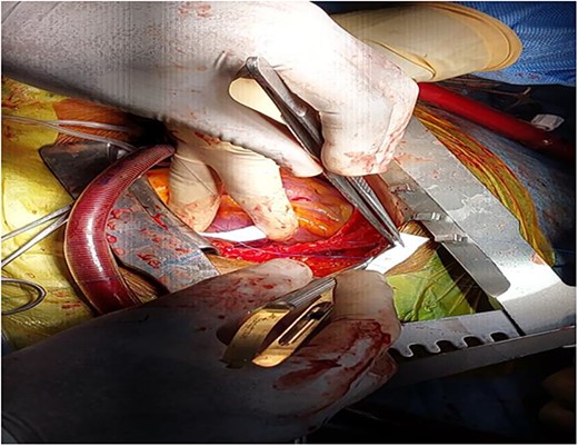 Picture depicting Teflon being used for closure of the defect.