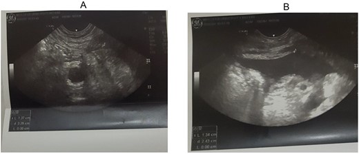 (A, B) Right lower quadrant ultrasound study showing dilated appendix and right lower quadrant fluid collection.