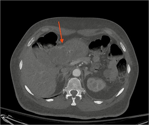 CT scan image of abdomen showing heterogenous gastric mass (red arrow).