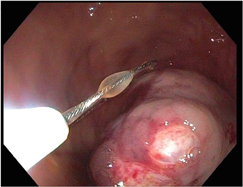 A large fungating gastric mass arising from the body of the stomach on endoscopy.