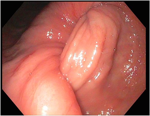 Gastric intussusception into pylorus on endoscopy.