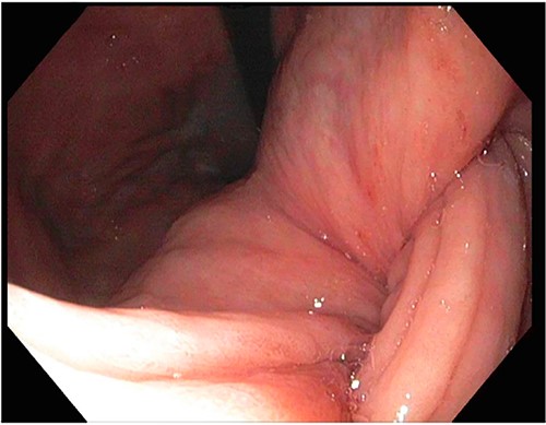 Gastric intussusception into pylorus on endoscopy.