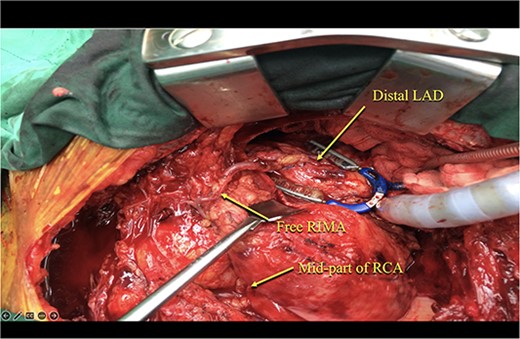 The free RIMA was anastomosed to the mid-part of RCA and bypassed to the distal LAD.