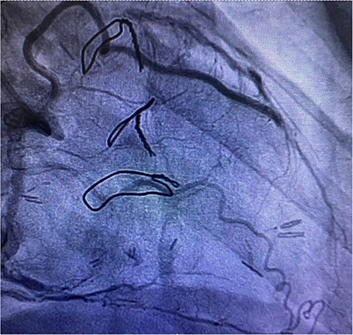 Post redoing coronary angiography showing patency of RIMA to LAD after 3 months.