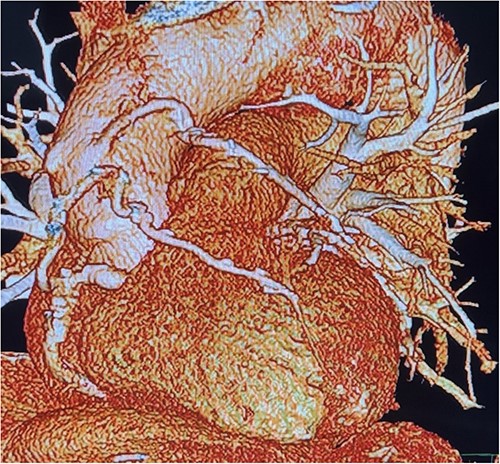 Cardiac computed tomography showing patency of RIMA to LAD 6 years after redoing CABG operation.