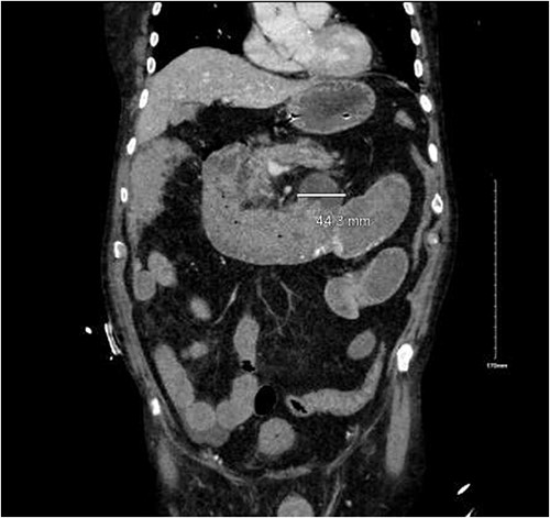 Duodenal diverticulum.