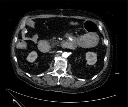 Angiodysplasia in duodenal diverticulum.