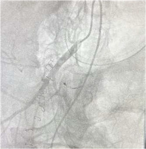 Post-embolization no contrast leak.