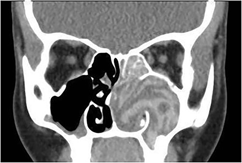 Coronal CT paranasal sinuses shows unilateral heterogeneous opacity of the obliterated left maxillary and ethmoid sinuses with extension through the widened remodeled ostiomeatal complex obliterating the left nasal cavity.