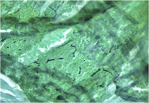 Fungal elements of a smear from paranasal sinus contents displayed using Grocott’s methenamine silver stain.