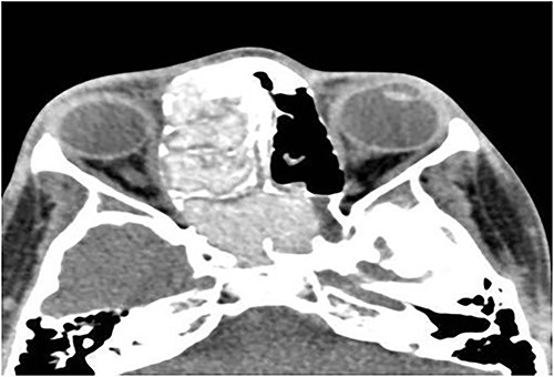 Axial CT paranasal sinuses shows the right ethmoid and sphenoid sinuses with complete obliteration and hyperdense (metallic) contents. It is associated with expansion of the ethmoid sinuses and lateral displacement of the right lamina papyracea causing right eye proptosis.