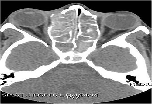 Axial CT paranasal sinuses shows heterogeneous opacities filling the ethmoid and sphenoid sinuses bilaterally with hyperdense contents. The ethmoid sinus shows expansion with partial dehiscence of the right lamina papyracea.