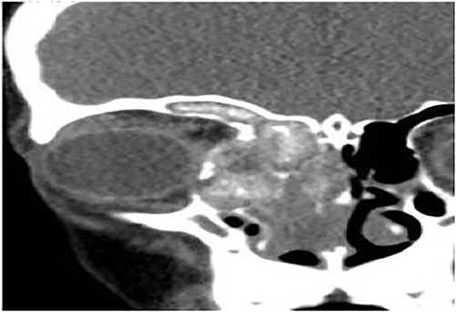 Coronal CT paranasal sinuses shows heterogeneous opacities filling the right frontal sinus with extension through the right frontal recess. It involves the ethmoid sinus with expansion. The right lamina papyracea shows lateral displacement with partial dehiscence and nasal polyposis.