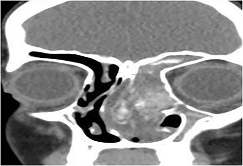 Coronal CT paranasal sinuses shows heterogeneous opacities filling the left frontal sinus with expansion of the left frontal recess & bone expansion and extension into the nasal cavity associated with nasal polyposis, resulting in near obliteration of the nasal cavity and deviation of the nasal septum to the right. Left maxillary antrum is involved. The right operated side is free of disease.