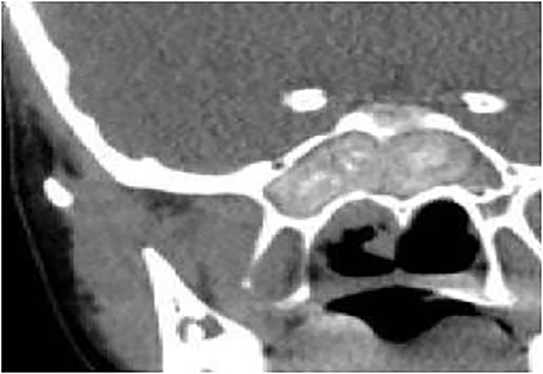 Coronal CT paranasal sinuses shows complete heterogeneous opacification of the sphenoid sinus with hyperdense contents and hypodense mucosa. No bone erosion or dehiscence were noted.