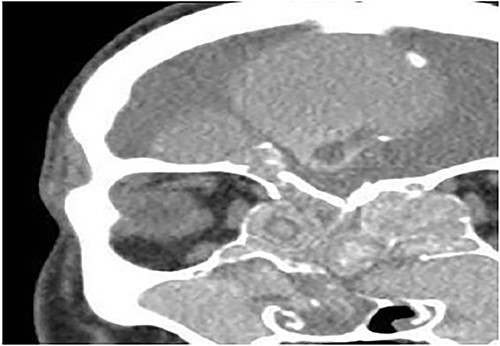 Coronal CT paranasal sinuses shows heterogeneous opacities of the ethmoid and maxillary sinuses bilaterally. It is associated with complete opacification and extension through the widened ostiomeatal complex, obliterating the nasal cavities with polyposis. The ethmoid sinuses show expansion with lateral displacement and partial dehiscence of the lamina papyracea bilaterally. The roof of the right ethmoid sinus shows dehiscence with intracranial extension.