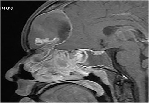 Sagittal T1 post contrast MRI paranasal sinuses shows expansion of the frontal sinus and anterior ethmoid with intracranial extension limited by the dura. The sphenoid sinus shows complete opacification and expansion displacing the pituitary fossa superiorly. The nasal cavity is obliterated by nasal polyposis.