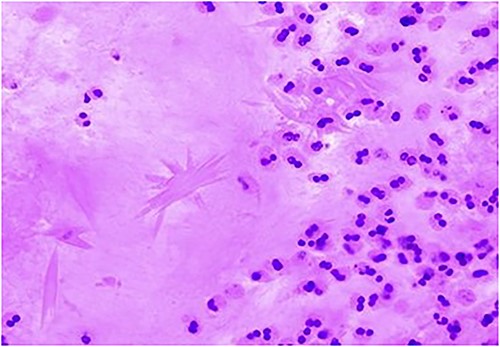 Charcot–Leyden crystal displayed using hematoxylin and eosin stain, indicating a mucin allergic in nature. It also shows non-invasive fungal hyphae & fungal elements with morphology consistent with Aspergillus species within the nasal mucus as in Fig. 10.