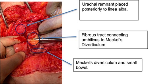 Intra-operative photograph showing small bowel and MD adherent to umbilicus.