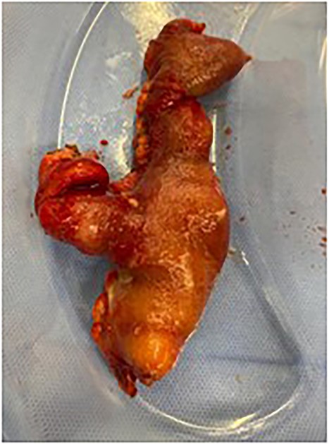 Resected specimen—small bowel with MD—resected from adherent umbilicus.