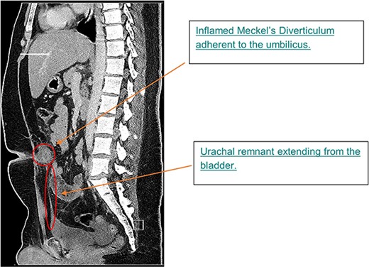 Sagittal image from CTAP at admission; CT showing inflamed MD at level of umbilicus and urachal remnant at apex of bladder tracking up to inflammatory mass.