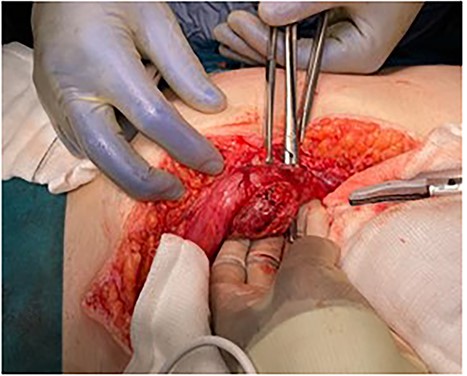 Umbilicus and abdominal wall following resection of MD.