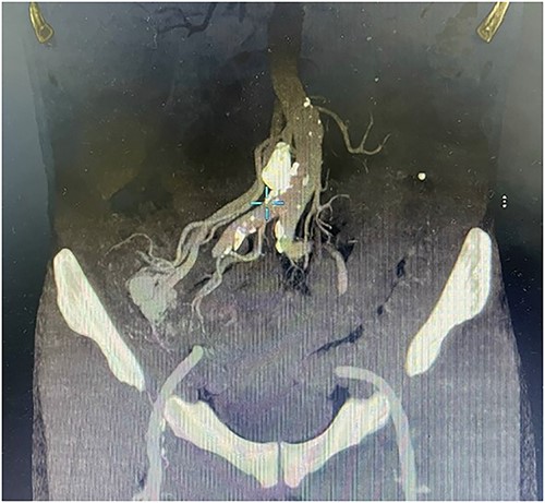 Contrast-enhanced abdominal CT showed a thickened appendix without signs of inflammation and images of vascular proliferation and dilated veins around the appendix.