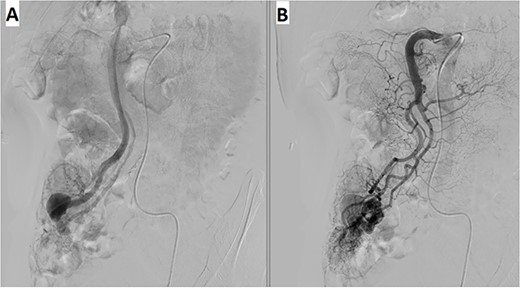 Angiography revealed (A) vascular tangle with (B) early venous filling in the appendicular artery and vein.