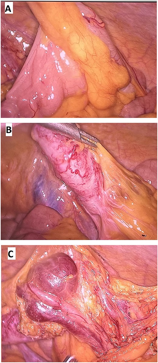 (A, B) Mesentary of the ileum was normal; (C) Thickened appendix with the AVM in the appendix mesentery.