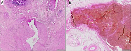 The hematoxylin and eosin stain demonstrated an AVM of the mesoappendix: (A) Thick and thin walled vessels in the submucosal layer and the muscular layer, (B) On high power field, large vessels with dilated lumens.