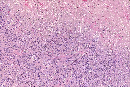 Microscopic examination reveals intersecting fascicles of monotonous spindle cells with indistinct borders, eosinophilic cytoplasm and cigar-shaped nuclei. There is necrosis on the right upper portion. Hematoxylin and Eosin 20×.