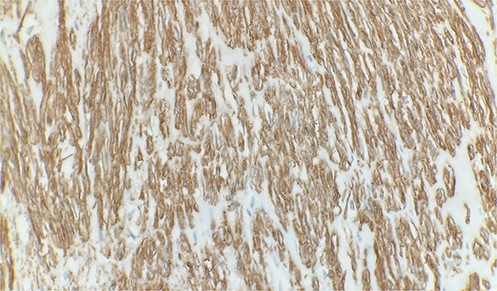 Immunohistochemical stain reveals tumor cells are positive for smooth muscle actin. Immunohistochemistry 40×.