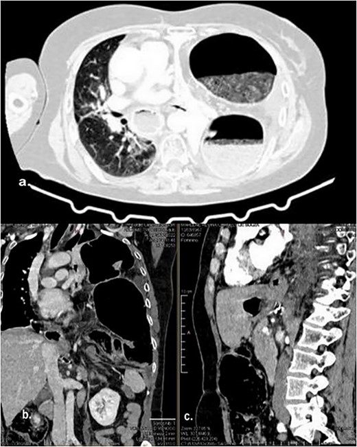 Different sections of the CT study demonstrate the mediastinal position of the transversal volvulus. (a) Axial CT section of the abdomen showing signs of esophagectomy with gastric lifting, a type IV hiatal hernia and colon herniation into the thorax. (b) The coronal CT section of colon herniation into the thorax. (c) The sagittal CT section of the thorax and the abdomen shows the posterior mediastinal position of the colon herniation into the thorax.