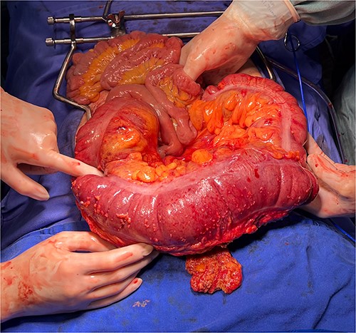 The intraoperative revealed colon herniation through the diaphragmatic hiatus, and the transverse colon appeared distended with erosions in the serosa.
