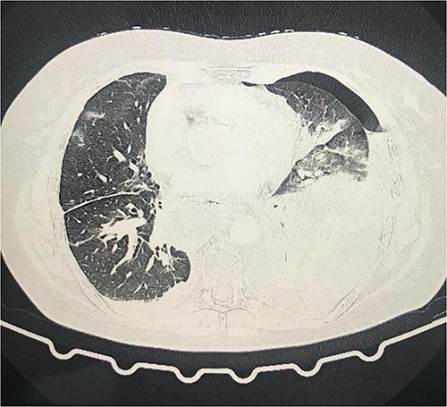 Second day follow-up showed a hydropneumothorax on the left chest CT scan.