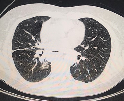 Normal chest CT scan.
