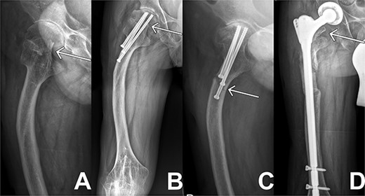 X-ray sequences of the right hip in different resolutions. (A) Representation of the medial femoral neck fracture before the first intervention as highlighted by arrow. (B) Osteosynthesis intervention of hip is highlighted by arrow few months after intervention. In addition, femoral deformity and knee rigidity are recognizable. (C) Periosteosynthetic fracture of the femoral shaft shortly before intervention. (D) Follow-up image of the inserted prosthesis material shows regular position.