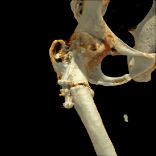 Three-dimensional reconstruction of computer tomography shows the patient’s periosteosynthetic fracture.
