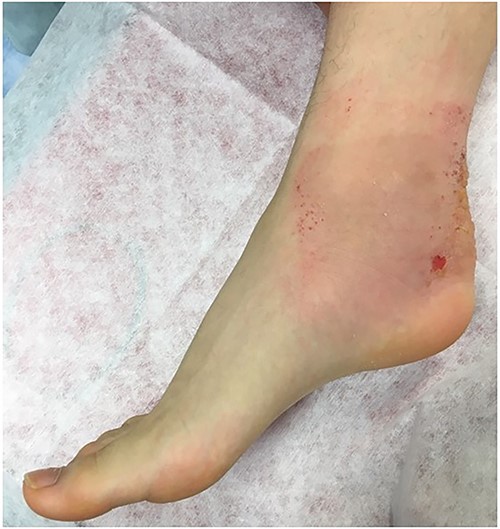 Right foot of the patient was in equinus position, and it was difficult to correct his foot position accurate due to his heel pain.