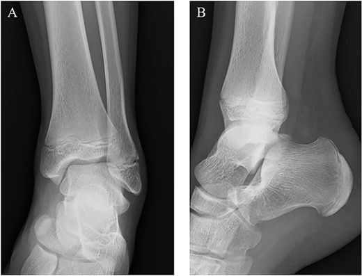 Plain radiographs of the right ankle showed no abnormal findings in (A) anteroposterior and (B) lateral views.