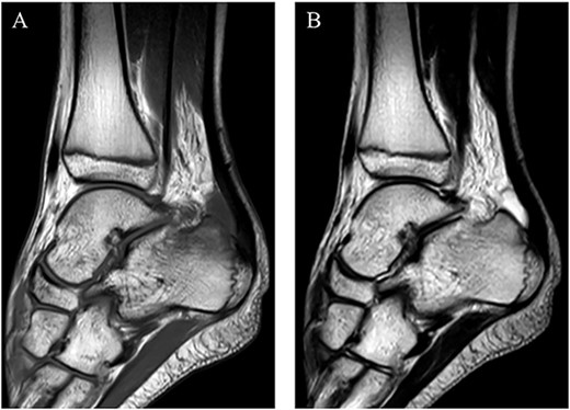 MRI demonstrated a low intensity signal (arrow) on (A) T1-weighted images and a high intensity signal (arrow) on (B) T2-weighted images in the retrocalcaneal bursa.