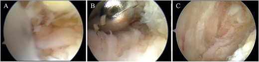 (A) Hyperemic synovium was located between the Achilles tendon and the posterosuperior calcaneal prominence and (B) removed with a 3.5-mm-diameter motorized shaver. (C) After confirming no impingement sign between the Achilles tendon and the posterosuperior calcaneal prominence, the surgery was concluded.