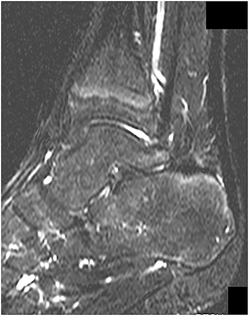 MRI revealed no abnormal signs on short TI inversion recovery images at 1 year postoperatively.