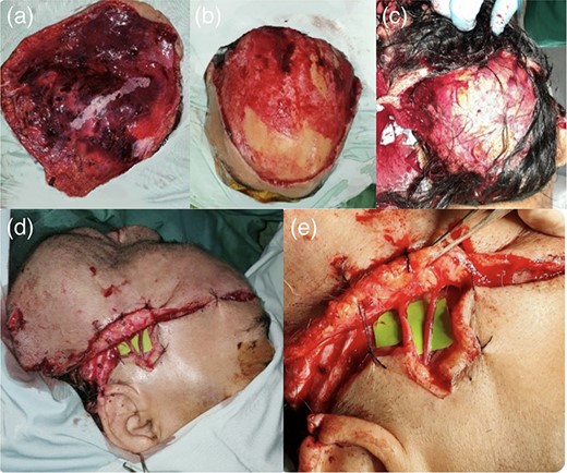 69-year-old woman with traumatic scalp amputation; (a) a total circular scalp avulsion with multi-level lacerated wounds; (b) an intact skull stump; (c) total detachment of the scalp exposing the skull stump; (d) scalp attachment with sutures to support the head shape and (e) an end-to-end anastomosis of the right superficial temporal artery and vein.