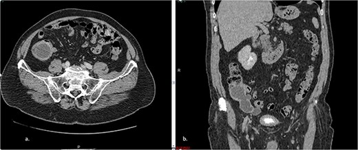 a. Axial CT section of the abdomen showing signs of mucocele of the appendix with intraluminal air. b. The coronal CT section of the appendix shows that the anterior wall of the appendix had an irregular thickening close to the transition of the middle/distal third.