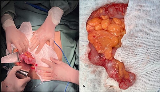 The intraoperative revealed a cystic mass measuring 9.2 × 3.4 × 3.0 cm was found in the right iliac fossa.
