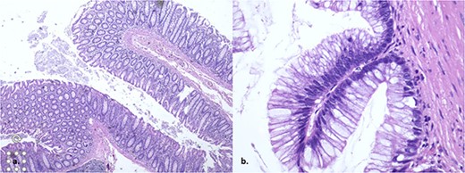 The histopathology showed a low-grade appendiceal mucinous neoplasm with no rupture and clear margins.